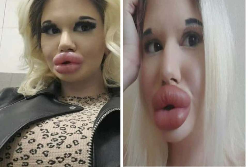 23 Years Old Girl With The ‘Biggest Lips In The World’ Plans To Have More Filler (Photos)