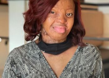 After 14 Years, Kechi Okwuchi, Sosoliso Plane Crash Survivor Shares Her Recovery Journey (Photos)