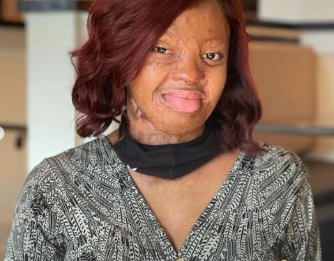 After 14 Years, Kechi Okwuchi, Sosoliso Plane Crash Survivor Shares Her Recovery Journey (Photos)