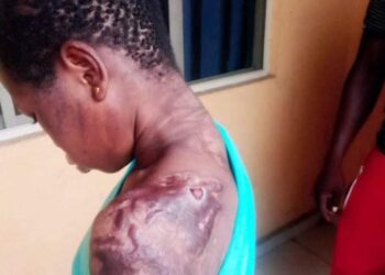 Woman Pours Hot Water On Her Housemaid For Breaking Plate (Graphic Photos)