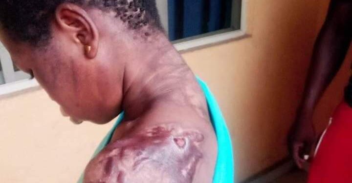 Woman Pours Hot Water On Her Housemaid For Breaking Plate (Graphic Photos)