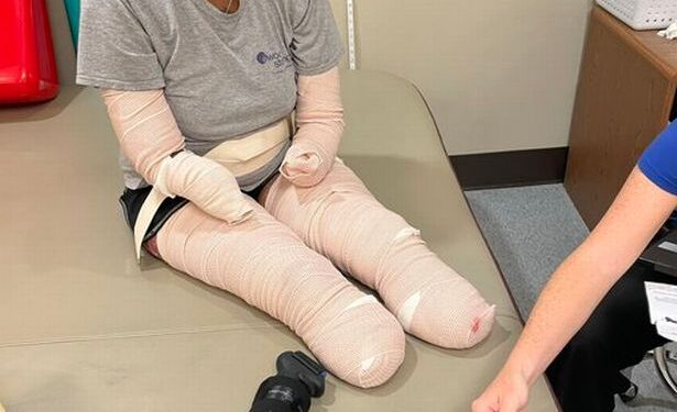 Mother Of Three Forced To Have Hands And Feet Amputated After Getting Covid19