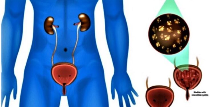 Why More Older Men Are Suffering From Urinary Tract Infections – Expert Reveals
