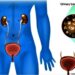 Why More Older Men Are Suffering From Urinary Tract Infections – Expert Reveals