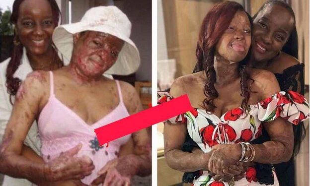 Sosoliso Crash Survivor, Kechi Appreciates Her Mum As She Shares Photo Of ‘A Year After The Crash’