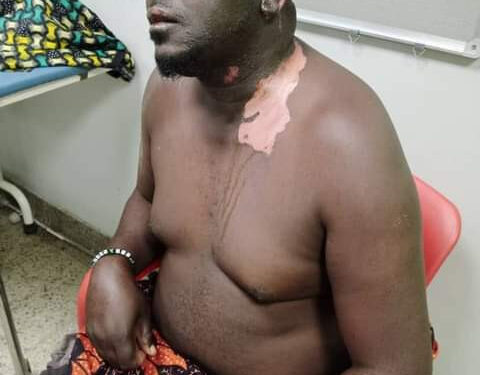 Woman Pours Hot Cooking Oil On Her Husband (Graphic Photos)
