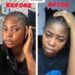 Nigerian Lady Laments After Laser Treatment She Underwent To Remove Her Tribal Mark left her With Worse Scars (Video)