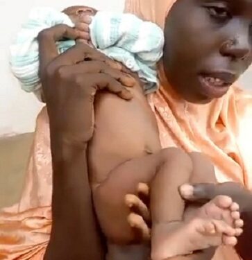 Baby Born With Her Twin Growing Out Of Her Butt (Photos “Viewers Discretion”)