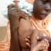 Baby Born With Her Twin Growing Out Of Her Butt (Photos “Viewers Discretion”)