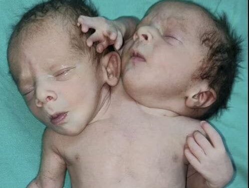Photo of Baby Born With Two Heads, Three Arms And Two Hearts