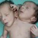 Photo of Baby Born With Two Heads, Three Arms And Two Hearts