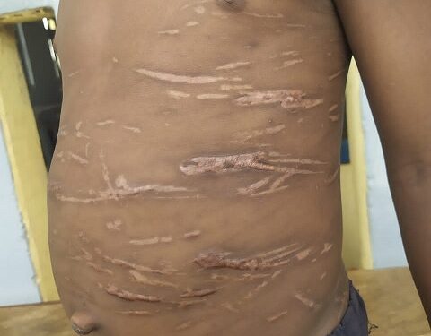 See The Unbelievable Photos Of 8-Year-Old Boy Who Was Gruesomely Tortured By His Teacher In Kano