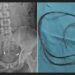 Man Gets 80cm Earphone Wire Stuck In His Bladder After Using It While M#sturbating