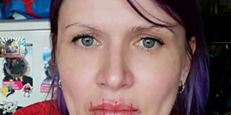 Russian Woman Sews Her Mouth To Protest Against Putin’s Anti-War Censorship
