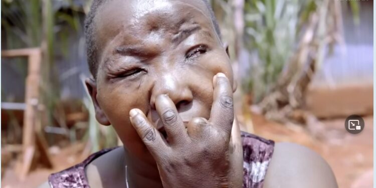 “My Jealous Husband Removed My Eye & Cut Off My Fingers” – Woman Recounts Sad Experience (Video)