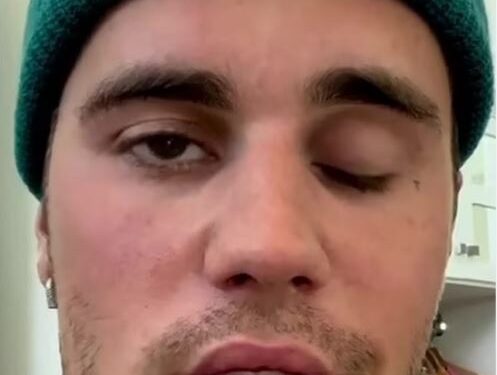 Justin Bieber ​Reveals That Half Of His Face Is Paralyzed After Being Diagnosed With Rare Disorder