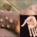 WHO Declares Monkeypox Global Health Emergency