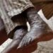 Just In: Osun Records First Case Of Monkeypox (Photos)
