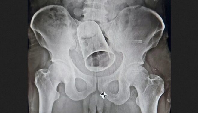 Doctors Remove Steel Cup From Man’s Rectum 10 Days After His Friends Inserted It
