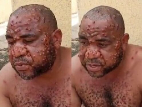 Nigerian Man Suffering From Monkey Pox Narrates How He Was Misdiagnosed By Multiple Doctors As He Opens Up About The Ailment (Video)
