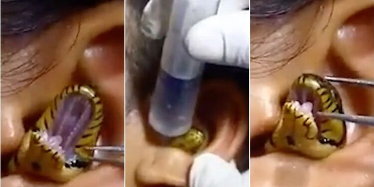 See The Shocking Moment A Surgeon Struggles To Remove Live Snake From Woman’s Ear (Video)