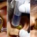 See The Shocking Moment A Surgeon Struggles To Remove Live Snake From Woman’s Ear (Video)