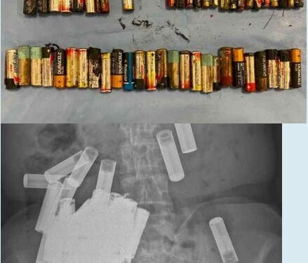 Shock as Doctors Remove 55 Batteries From 66-year-old Woman’s Stomach