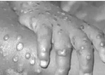 Nigeria now has 241 cases of monkeypox, Lassa fever 909 – NCDC