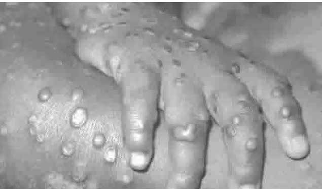 Nigeria now has 241 cases of monkeypox, Lassa fever 909 – NCDC