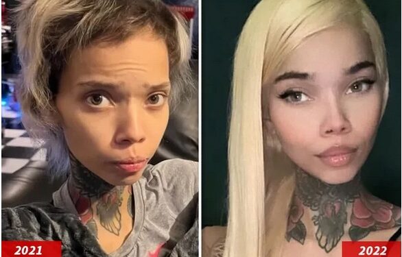 IG Model Who Is HIV Positive Is Now Blind After Eye Surgery