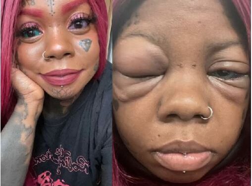 Mother Going Blind After Tattooing Her Eyeballs Blue And Purple To Copy An Influencer