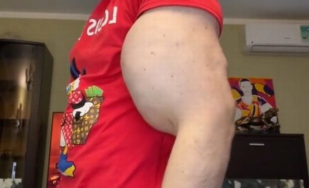 Meet The Bodybuilder Who Injected Oil Into Biceps To Make Them Big (Photos)