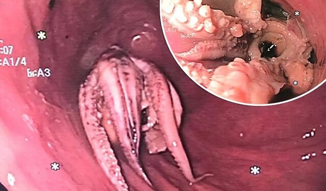 Doctors Remove Octopus From Patient’s Throat (Photos)