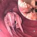 Doctors Remove Octopus From Patient’s Throat (Photos)