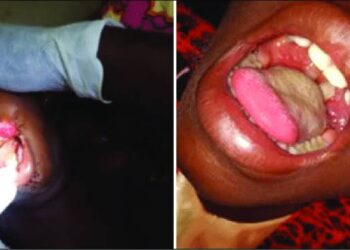 One Dies Of Diphtheria In Osun