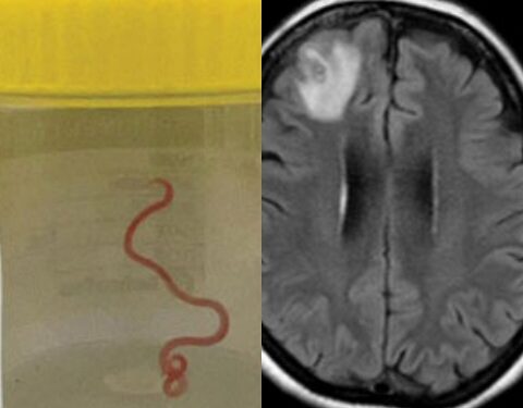 Surgeons Find Worm Living In Woman’s Brain in World’s First Case After She Complained For Years Of Having Migraine And Pneumonia (Photos)