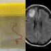 Surgeons Find Worm Living In Woman’s Brain in World’s First Case After She Complained For Years Of Having Migraine And Pneumonia (Photos)