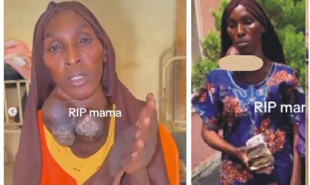 Osun Woman Who Chose N300k Over Free Surgery To Remove Goiter Is Dead (Video)