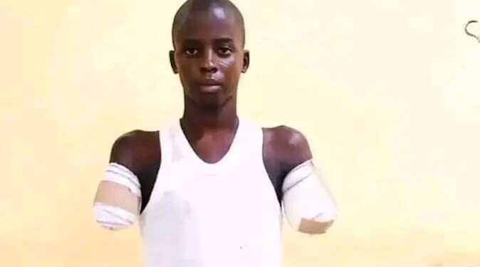 Gombe Govt To Prosecute Man For Amputating His Nephew’s Hands Over Alleged Phone Theft