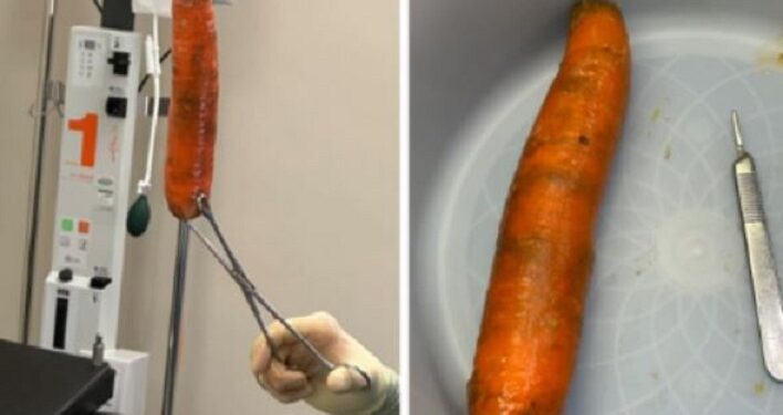 “Stop Putting Foreign Objects Down Your Anuses” – Doctor Warns After His Team Successfully Removed A Carrot From A Male Patient’s Anus (Photos)