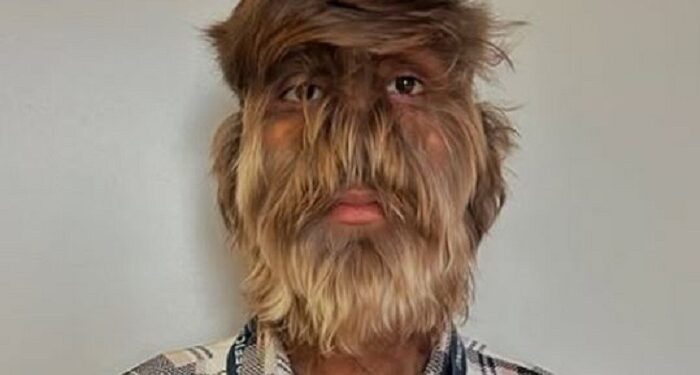 18-Year-Old Indian Boy Suffering From “Werewolf Syndrome” Makes Guinness World Record For Hairiest Face (Photos)