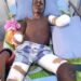 Taraba Poly Student Loses Both Hands While Hoisting PDP Flag