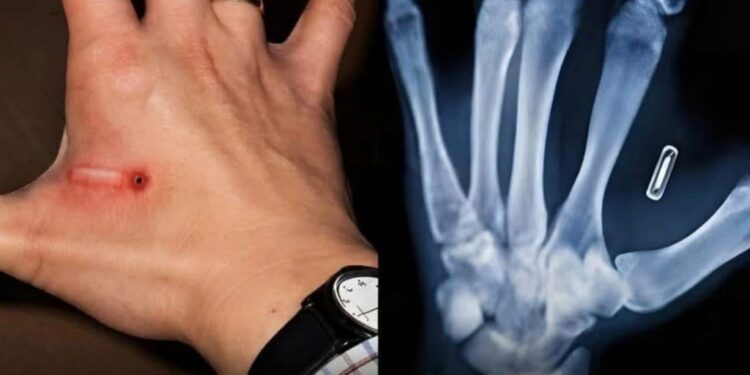 Sweden Implants Microchips In Citizens To Replace IDs and Credit Cards
