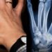 Sweden Implants Microchips In Citizens To Replace IDs and Credit Cards